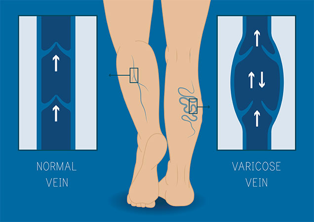 Chronic Venous Insufficiency Guide