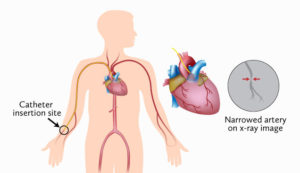 Coronary Angiogram Diagram