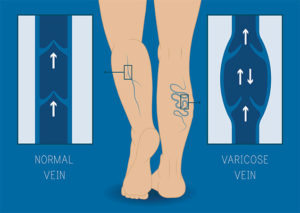 Lower Extremity Venous with Reflux Ultrasound Normal Vein Left, Varicose Vein Right