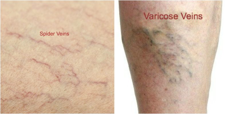 do-i-have-varicose-veins-cardiovascular-institute-of-the-shoals